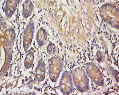IHC-P analysis of human colon cancer tissue using GTX37320 VAMP3 antibody. IHC-P analysis of human colon cancer tissue using GTX37320 VAMP3 antibody.