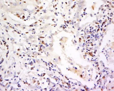 IHC-P analysis of human lung carcinoma tissue using GTX37330 CD94 antibody. IHC-P analysis of human lung carcinoma tissue using GTX37330 CD94 antibody.