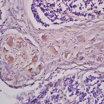 IHC-P analysis of human lung carcinoma tissue using GTX37416 mGluR1 antibody. Dilution : 1:200 IHC-P analysis of human lung carcinoma tissue using GTX37416 mGluR1 antibody. Dilution : 1:200
