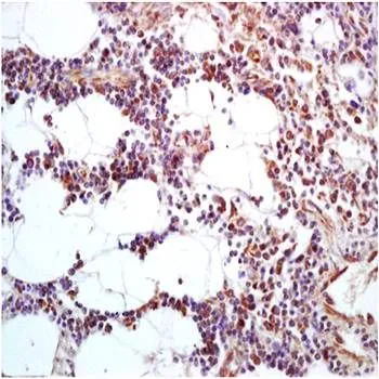 IHC-P analysis of human lung carcinoma tissue using GTX37435 CLEC4A antibody. Fixation : 4% PFA Antigen retireval : boiling with citrate buffer Dilution : 1:200 IHC-P analysis of human lung carcinoma tissue using GTX37435 CLEC4A antibody. Fixation : 4% PFA Antigen retireval : boiling with citrate buffer Dilution : 1:200