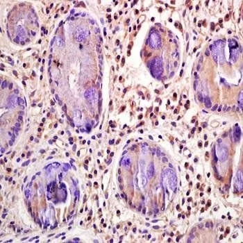 IHC-P analysis of human gastric carcinoma tissue using GTX37451 CD33 antibody. Dilution : 1:200 IHC-P analysis of human gastric carcinoma tissue using GTX37451 CD33 antibody. Dilution : 1:200