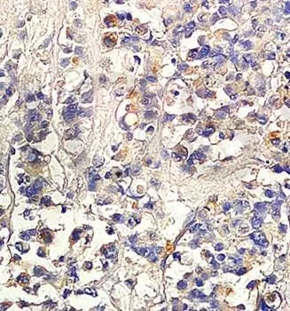 IHC-P analysis of human colon carcinoma tissue using GTX37528 TGF beta 2 antibody. IHC-P analysis of human colon carcinoma tissue using GTX37528 TGF beta 2 antibody.