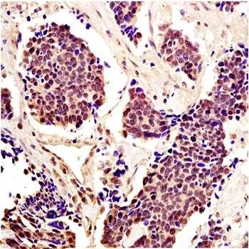 IHC-P analysis of human lung carcinoma tissue using GTX37534 STAT5 antibody. Fixation : 4% PFA Antigen retireval : boiling with citrate buffer Dilution : 1:200 IHC-P analysis of human lung carcinoma tissue using GTX37534 STAT5 antibody. Fixation : 4% PFA Antigen retireval : boiling with citrate buffer Dilution : 1:200