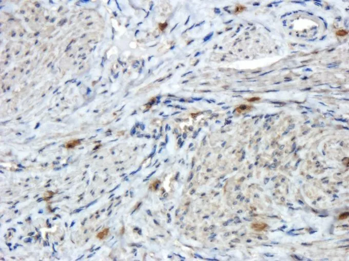 IHC-P analysis of human endometrial cancer tissue using GTX37552 Reelin antibody. Dilution : 2.5ug/ml