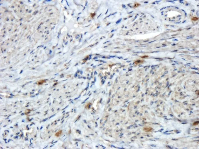 IHC-P analysis of human endometrial cancer tissue using GTX37552 Reelin antibody. Dilution : 2.5microg/ml