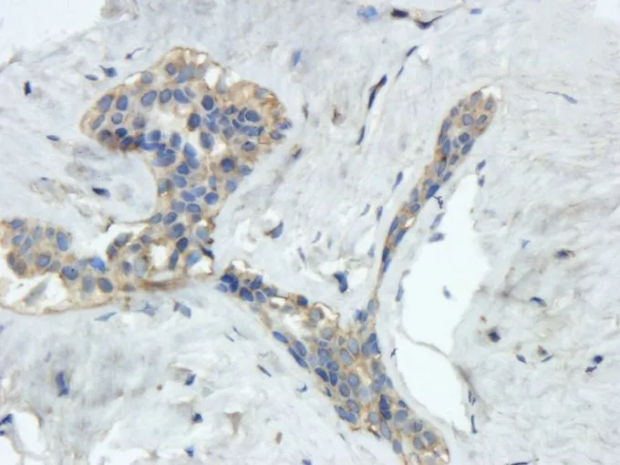 IHC-P analysis of human mammary fibroma tissue using GTX37552 Reelin antibody. Dilution : 2.5microg/ml