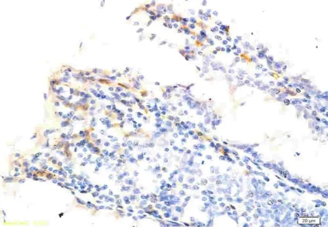 IHC-P analysis of human rectum cancer tissue using GTX37582 Osteopontin antibody.