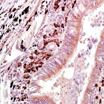 IHC-P analysis of human lung carcinoma tissue using GTX37589 OAS1 antibody. Dilution : 1:200 IHC-P analysis of human lung carcinoma tissue using GTX37589 OAS1 antibody. Dilution : 1:200