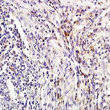 IHC-P analysis of human colon carcinoma tissue using GTX37600 Lipocalin-2 antibody. Dilution : 1:200 IHC-P analysis of human colon carcinoma tissue using GTX37600 Lipocalin-2 antibody. Dilution : 1:200