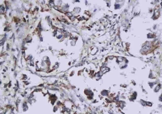 IHC-P analysis of human lung cancer tissue using GTX37670 Histone H3 antibody.