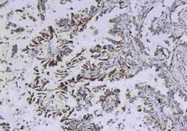IHC-P analysis of human adenocarcinoma tissue using GTX37670 Histone H3 antibody. Dilution : 1:200
