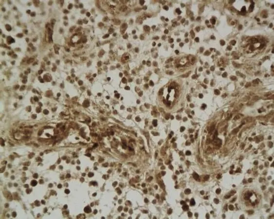 IHC-P analysis of human middle ear granulation tissue using GTX37716 beta 2 Defensin antibody. Dilution : 1:200