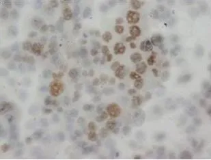 IHC-P analysis of human epidermic carcinoma tissue using GTX38554 API5 antibody. IHC-P analysis of human epidermic carcinoma tissue using GTX38554 API5 antibody.