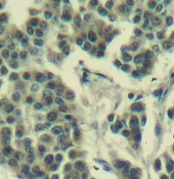 IHC-P analysis of human breast carcinoma tissue using GTX38571 Her3 / ErbB3 (phospho Tyr1328) antibody.