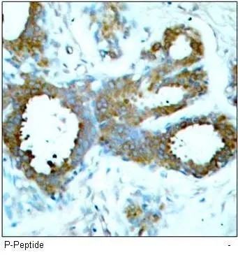 IHC-P analysis of human breast cacinoma tissue using GTX38587 PAK1 ( phospho Thr423 ) / PAK2 ( phospho Thr402 ) / PAK3 ( phospho Thr436 ) antibody.