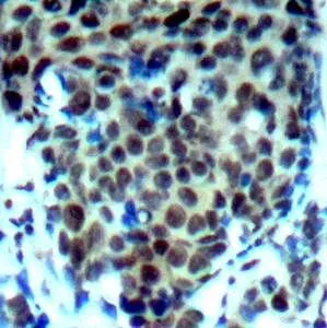 IHC-P analysis of human breast carcinoma tissue using GTX38595 p38 MAPK (phospho Thr180) antibody. IHC-P analysis of human breast carcinoma tissue using GTX38595 p38 MAPK (phospho Thr180) antibody.
