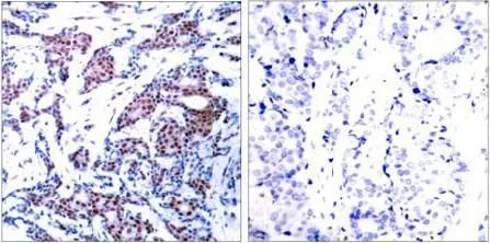 IHC-P analysis of human breast cacinoma tissue using GTX38608 c-Jun (phospho Ser73) antibody. with(right) or without(left) preincubated with blocking peptide. IHC-P analysis of human breast cacinoma tissue using GTX38608 c-Jun (phospho Ser73) antibody. with(right) or without(left) preincubated with blocking peptide.