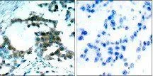 IHC-P analysis of human lung carcinoma tissue using GTX38611 PKC theta (phospho Ser695) antibody. with(right) or without(left) preincubated with blocking peptide.