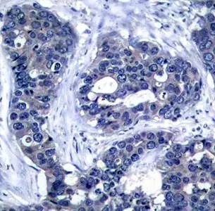 IHC-P analysis of human breast carcinoma tissue using GTX38614 IRS1 (phospho Ser639) antibody. IHC-P analysis of human breast carcinoma tissue using GTX38614 IRS1 (phospho Ser639) antibody.