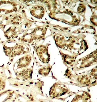 IHC-P analysis of human breast carcinoma tissue using GTX38634 MEF2A (phospho Ser408) antibody. IHC-P analysis of human breast carcinoma tissue using GTX38634 MEF2A (phospho Ser408) antibody.