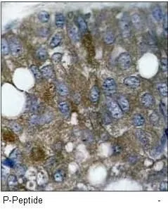 IHC-P analysis of human breast cacinoma tissue using GTX38674 HSP27 (phospho Ser15) antibody.