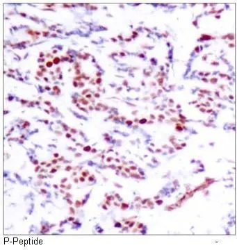 IHC-P analysis of human breast cacinoma tissue using GTX38683 ATF2 (phospho Ser112) antibody. IHC-P analysis of human breast cacinoma tissue using GTX38683 ATF2 (phospho Ser112) antibody.
