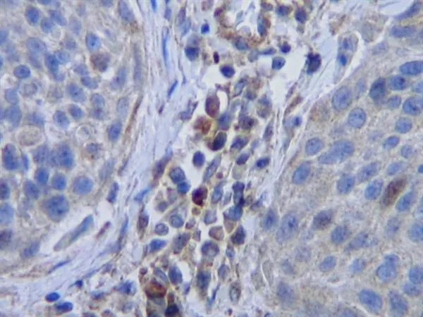 IHC-P analysis of human cervical squamous cell carcinoma using GTX39776 M-CSF antibody. Heat mediated antigen retrieval using citrate buffer pH6.0. IHC-P analysis of human cervical squamous cell carcinoma using GTX39776 M-CSF antibody. Heat mediated antigen retrieval using citrate buffer pH6.0.