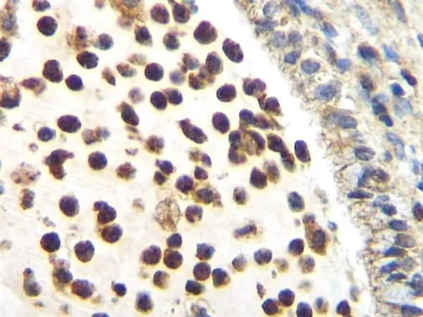 IHC-P analysis of human cervical squamous cell carcinoma using GTX39776 M-CSF antibody. Heat mediated antigen retrieval using citrate buffer pH6.0.