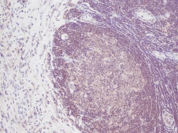 IHC-P analysis of human breast invasive ductal carcinoma using GTX39952 IL2 antibody.