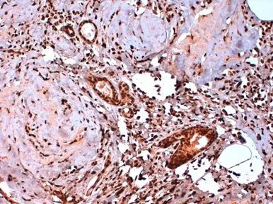 IHC-P analysis of human breast cancer tissue using GTX41212 Estrogen Receptor beta 5 antibody [5/25].