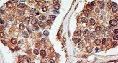IHC-P analysis of human breast carcinoma tissue using GTX46123 p73 antibody [5B429]. Dilution : 5 microg/ml Antigen retrieval : 10 mM sodium citrate buffer, pH 6.0