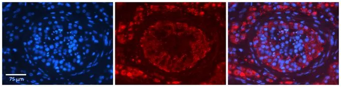 IHC-P analysis of human testis tissue using GTX46488 EPRS antibody at 1:600. Left to right:DAPI, EPRS, Merge. Heat-induced antigen retrieval method utilizing Sodium Citrate buffer was performed. IHC-P analysis of human testis tissue using GTX46488 EPRS antibody at 1:600. Left to right:DAPI, EPRS, Merge. Heat-induced antigen retrieval method utilizing Sodium Citrate buffer was performed.