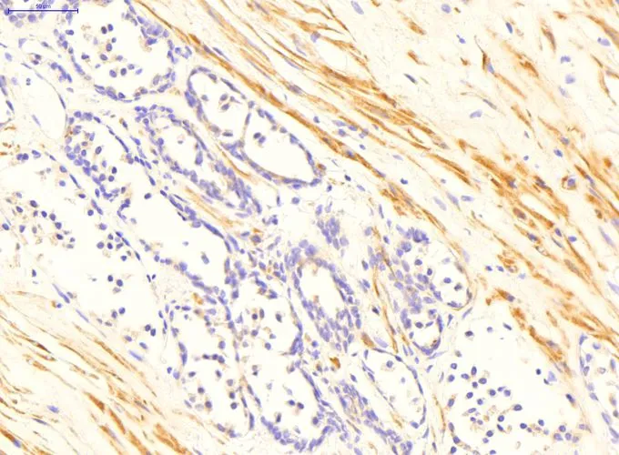 IHC-P analysis of human prostate tissue using GTX47079 TGM4 antibody at 2microg/ml. Leica Bond antigen retrieval solution 1 (citrate buffer, pH 6.0) for 20 min at 99 degree C. IHC-P analysis of human prostate tissue using GTX47079 TGM4 antibody at 2microg/ml. Leica Bond antigen retrieval solution 1 (citrate buffer, pH 6.0) for 20 min at 99 degree C.