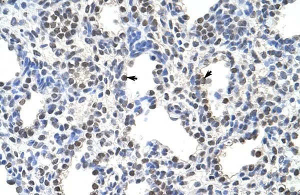 IHC-P analysis of human lung tissue using GTX47232 FUSIP1 antibody at 4.0-8.0microg/ml. IHC-P analysis of human lung tissue using GTX47232 FUSIP1 antibody at 4.0-8.0microg/ml.