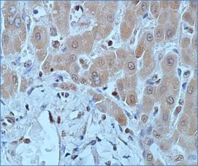 IHC-P analysis of human hepatocellular carcinoma tissue using GTX48548 DNMT1 antibody [60B1220.1]. Dilution : 1:50
