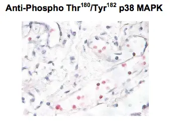 Immunostaining of human breast cancer tissue showing p38 when phosphorylated at Thr180/Tyr182 in red using p38 MAPK (phospho Thr180/Tyr182) antibody (GTX48614) Immunostaining of human breast cancer tissue showing p38 when phosphorylated at Thr180/Tyr182 in red using p38 MAPK (phospho Thr180/Tyr182) antibody (GTX48614)