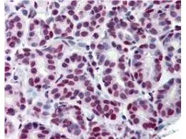 Immunohistochemistry using GeneTexs Anti-Stat5 pY694 monoclonal antibody shows detection of phosphorylated Stat5pY694 in human breast tissue (40X). The antibody was used a dilution to 20 microg/mL. The image shows breast epithelium with moderate nuclear staining. Tissue was formalin fixed and paraffin embedded. No pre-treatment of sample was required. The image shows the localization of antibody as the precipitated red signal, with a hematoxylin purple nuclear counterstain.