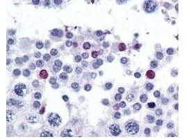 GeneTexs affinity purified anti-SPANX-C antibody was used at 2.5 microg/ml to detect signal in a variety of tissues including multi-human, multi-brain and multi-cancer slides. This image shows moderate positive staining of human sperm and spermatids at 60X. Tissue was formalin-fixed and paraffin embedded. The image shows localization of the antibody as the precipitated red signal, with a hematoxylin purple nuclear counterstain. GeneTexs affinity purified anti-SPANX-C antibody was used at 2.5 microg/ml to detect signal in a variety of tissues including multi-human, multi-brain and multi-cancer slides. This image shows moderate positive staining of human sperm and spermatids at 60X. Tissue was formalin-fixed and paraffin embedded. The image shows localization of the antibody as the precipitated red signal, with a hematoxylin purple nuclear counterstain.