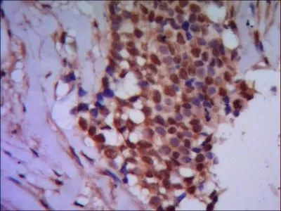 IHC-P analysis of human breast cancer using PPP4C antibody.