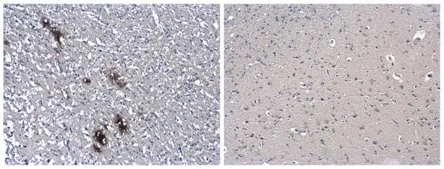 Beta amyloid (1-42) antibody (conformation specific) detects beta amyloid protein aggregates by immunohistochemical analysis in the occipital lobe of Alzheimers disease brain (left), but not in normal human brain(right). Sample: Paraffin-embedded Human Brain (Alzheimers Disease + Normal) tissue slides (GTX49382). beta amyloid protein aggregates stained by beta amyloid (1-42) antibody - Conformation Specific (GTX49382) diluted at 1:500.