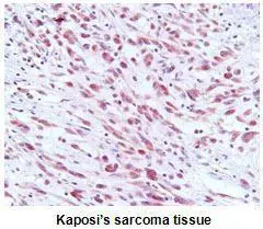 Paraffin embedded sections of Kaposi�s sarcoma tissue were incubated with anti-ORF73/HHV8 (1:50) for 2 hours at room temperature. Antigen retrieval was performed in 0.1M sodium citrate buffer and detected using Diaminobenzidine (DAB)