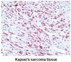 Paraffin embedded sections of Kaposis sarcoma tissue were incubated with anti-KSHV ORF73 (1:50) for 2 hours at room temperature. Antigen retrieval was performed in 0.1M sodium citrate buffer and detected using Diaminobenzidine (DAB)