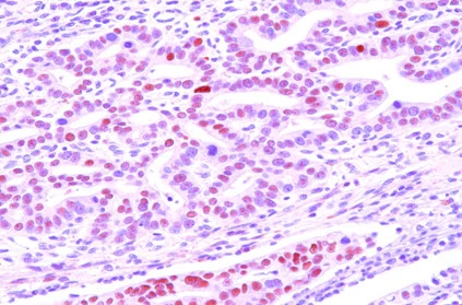 Paraffin embedded sections of human gastric cancer tissue were incubated with anti-human DACT3 (1:50, GTX50032) for 2 hours at room temperature. Antigen retrieval was performed in 0.1M sodium citrate buffer and detected using Diaminobenzidine (DAB) Paraffin embedded sections of human gastric cancer tissue were incubated with anti-human DACT3 (1:50, GTX50032) for 2 hours at room temperature. Antigen retrieval was performed in 0.1M sodium citrate buffer and detected using Diaminobenzidine (DAB)