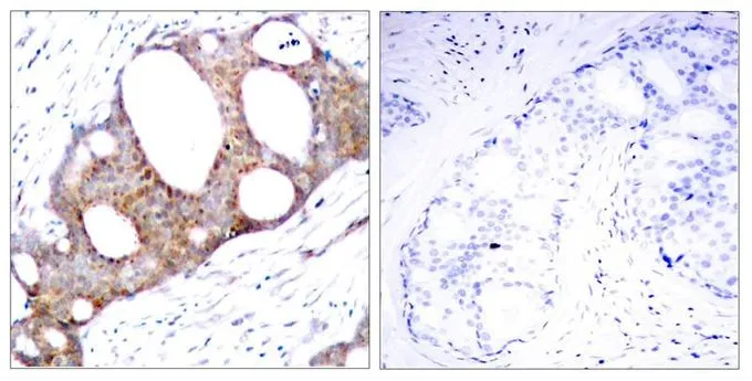 IHC-P analysis of human breast carcinoma tissue using GTX50095 GSK3 alpha (phospho Ser21) antibody. Left : Primary antibody Right : Primary antibody pre-incubated with the antigen specific peptide