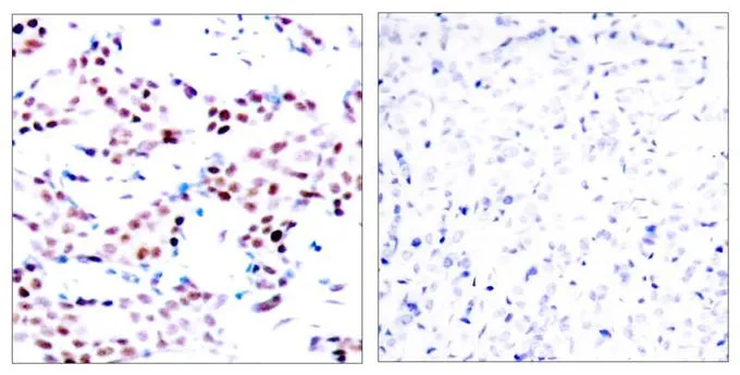 IHC-P analysis of human breast carcinoma tissue using GTX50100 c-Jun (phospho Thr91) antibody. Left : Primary antibody Right : Primary antibody pre-incubated with the antigen specific peptide IHC-P analysis of human breast carcinoma tissue using GTX50100 c-Jun (phospho Thr91) antibody. Left : Primary antibody Right : Primary antibody pre-incubated with the antigen specific peptide