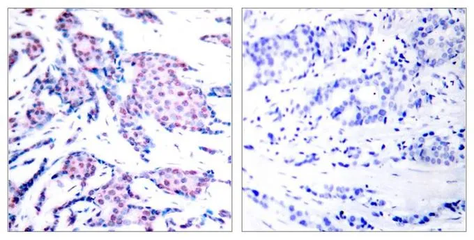 IHC-P analysis of human breast carcinoma tissue using GTX50101 c-Jun (phospho Thr93) antibody. Left : Primary antibody Right : Primary antibody pre-incubated with the antigen specific peptide IHC-P analysis of human breast carcinoma tissue using GTX50101 c-Jun (phospho Thr93) antibody. Left : Primary antibody Right : Primary antibody pre-incubated with the antigen specific peptide