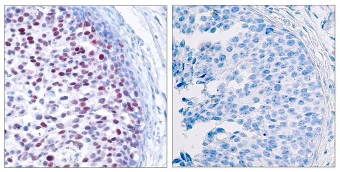 IHC-P analysis of human breast carcinoma tissue using GTX50103 c-Jun (phospho Thr239) antibody. Left : Primary antibody Right : Primary antibody pre-incubated with the antigen specific peptide