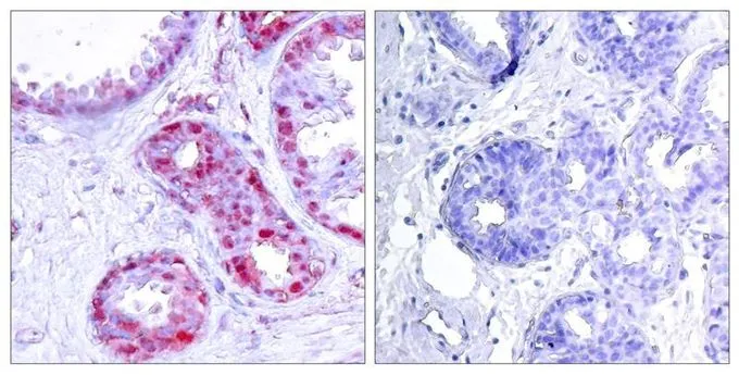 IHC-P analysis of human breast carcinoma tissue using GTX50104 c-Jun (phospho Ser243) antibody. Left : Primary antibody Right : Primary antibody pre-incubated with the antigen specific peptide IHC-P analysis of human breast carcinoma tissue using GTX50104 c-Jun (phospho Ser243) antibody. Left : Primary antibody Right : Primary antibody pre-incubated with the antigen specific peptide