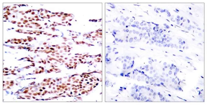 IHC-P analysis of human breast carcinoma tissue using GTX50105 JunB (phospho Ser79) antibody. Left : Primary antibody Right : Primary antibody pre-incubated with the antigen specific peptide