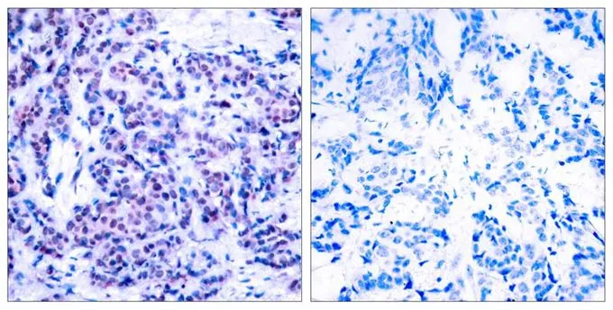 IHC-P analysis of human breast carcinoma tissue using GTX50107 JunD (phospho Ser255) antibody. Left : Primary antibody Right : Primary antibody pre-incubated with the antigen specific peptide